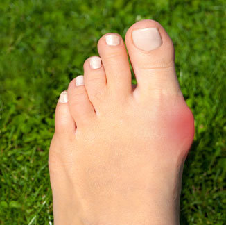foot with red bunion